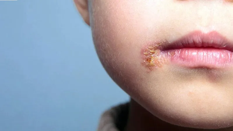 Embora a doença seja mais frequente entre crianças dos 2 aos 5 anos, na Madeira o maior número de casos terá sido identificado entre alunos de uma escola secundária, logo acima dos 15 ou 16 anos de idade.&nbsp;