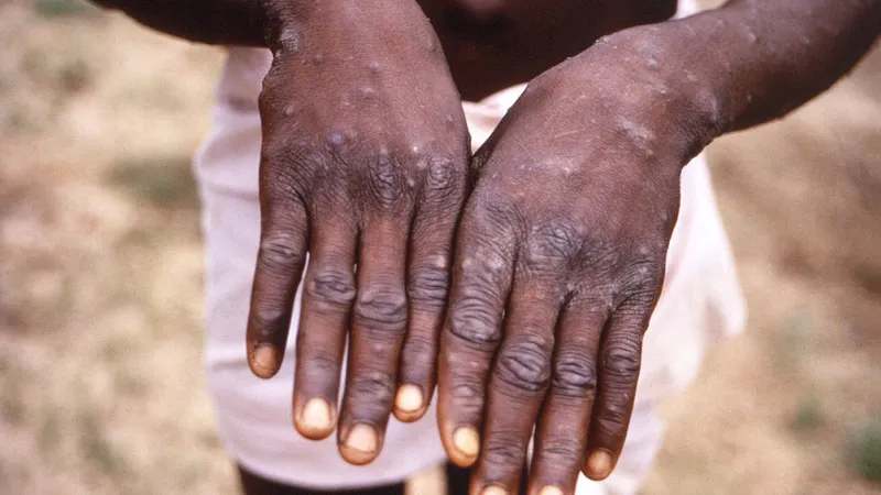 Foto Brian W.J. Mahy/Centers for Disease Control and Prevention/AFP